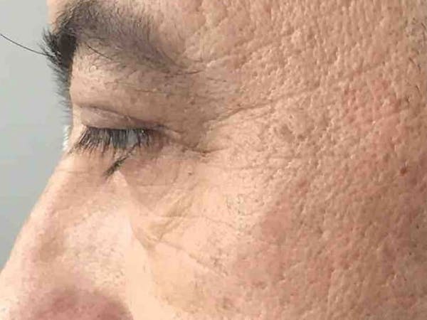 Blepharoplasty Before & After Gallery - Patient 427209 - Image 4