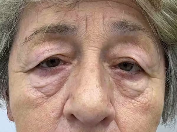 Blepharoplasty Before & After Gallery - Patient 294988 - Image 1
