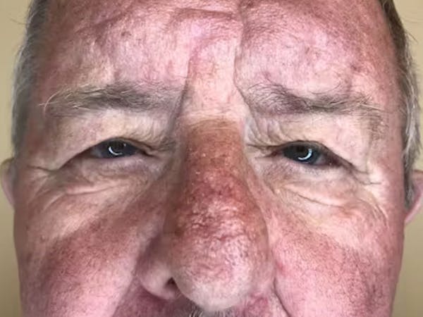 Blepharoplasty Before & After Gallery - Patient 218485 - Image 1