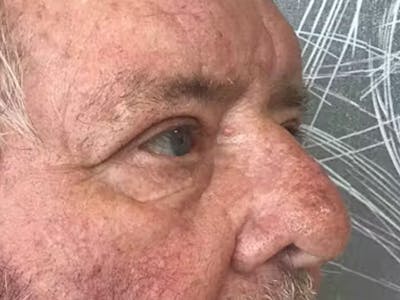 Blepharoplasty Before & After Gallery - Patient 218485 - Image 4