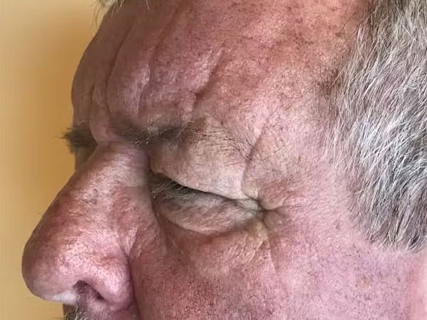 Blepharoplasty Before & After Gallery - Patient 218485 - Image 5