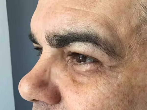 Blepharoplasty Before & After Gallery - Patient 411725 - Image 1