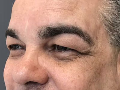 Blepharoplasty Before & After Gallery - Patient 411725 - Image 2