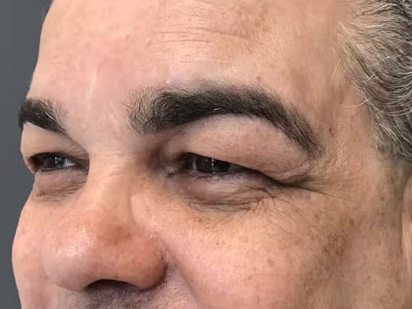 Blepharoplasty Before & After Gallery - Patient 411725 - Image 2