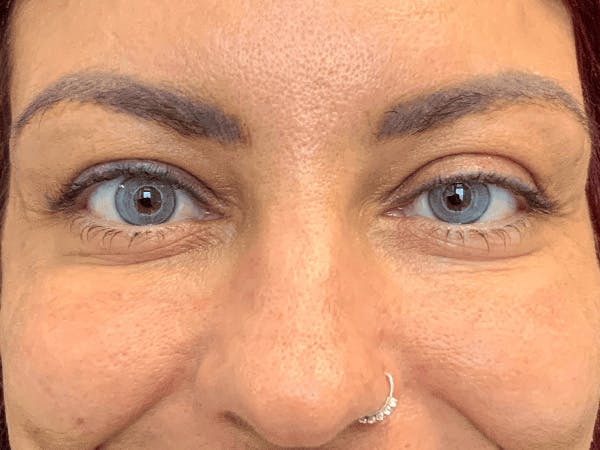Blepharoplasty Before & After Gallery - Patient 258521 - Image 1