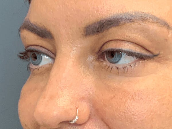 Blepharoplasty Before & After Gallery - Patient 258521 - Image 5