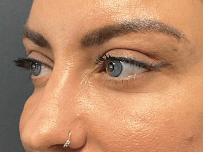 Blepharoplasty Before & After Gallery - Patient 258521 - Image 6