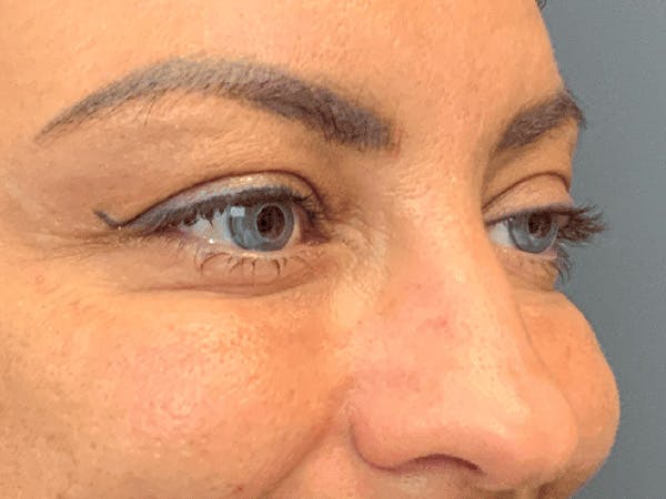 Blepharoplasty Before & After Gallery - Patient 258521 - Image 3