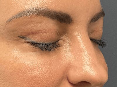 Blepharoplasty Before & After Gallery - Patient 258521 - Image 4