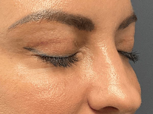 Blepharoplasty Before & After Gallery - Patient 258521 - Image 4
