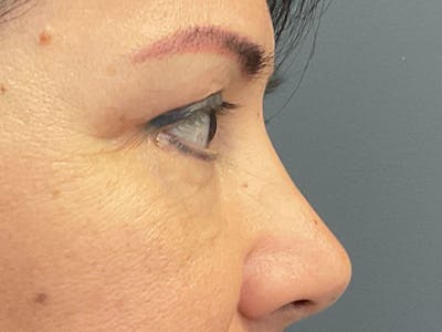 Blepharoplasty Before & After Gallery - Patient 412987 - Image 8