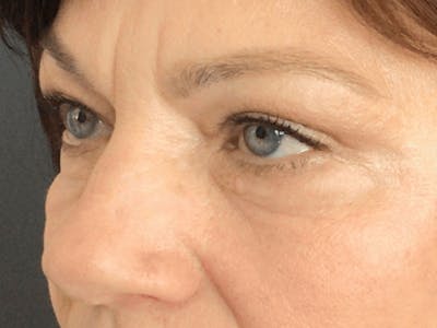 Blepharoplasty Before & After Gallery - Patient 362991 - Image 4