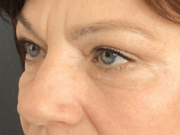 Blepharoplasty Before & After Gallery - Patient 362991 - Image 4