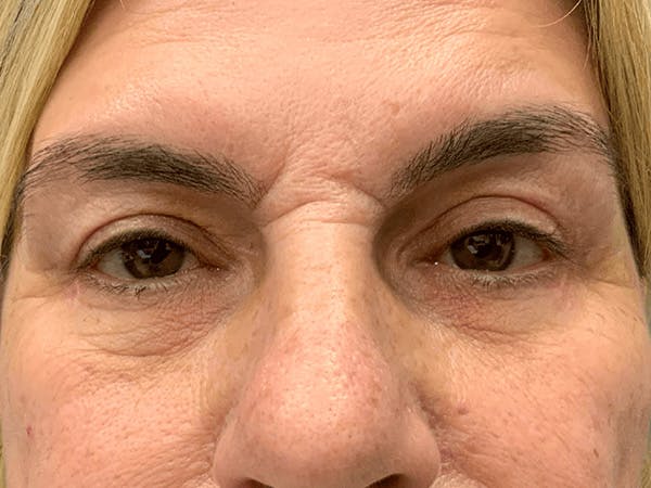 Blepharoplasty Before & After Gallery - Patient 146869 - Image 2