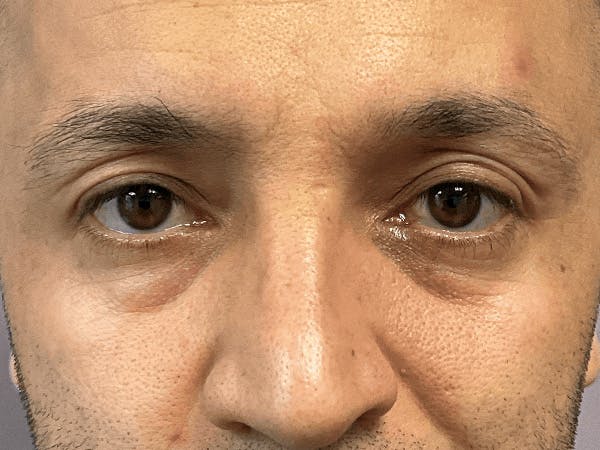 Blepharoplasty Before & After Gallery - Patient 206602 - Image 1