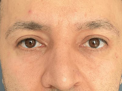 Blepharoplasty Before & After Gallery - Patient 206602 - Image 2