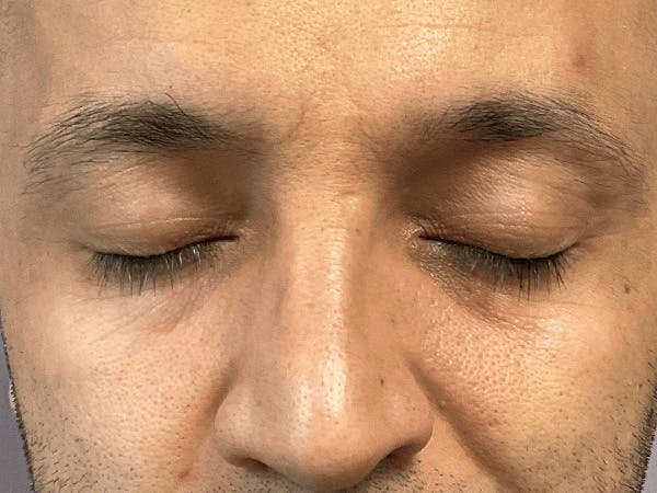 Blepharoplasty Before & After Gallery - Patient 206602 - Image 3