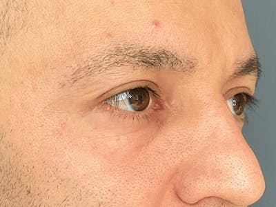 Blepharoplasty Before & After Gallery - Patient 206602 - Image 6
