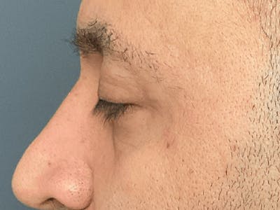 Blepharoplasty Before & After Gallery - Patient 206602 - Image 12