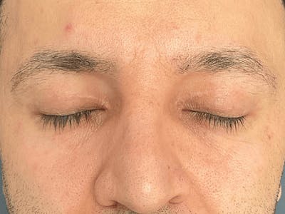 Blepharoplasty Before & After Gallery - Patient 206602 - Image 4