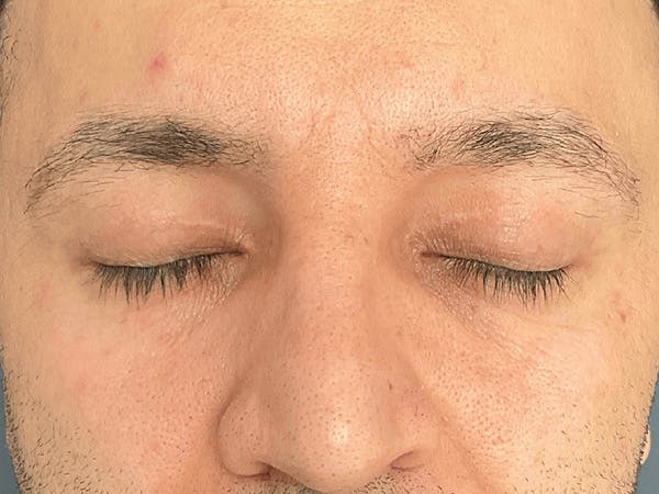 Blepharoplasty Before & After Gallery - Patient 206602 - Image 4