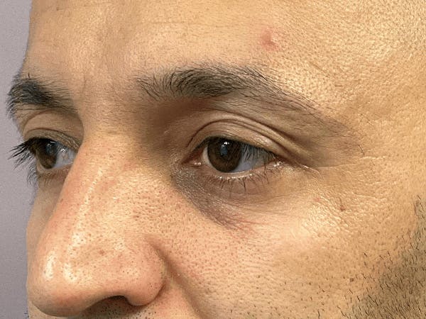 Blepharoplasty Before & After Gallery - Patient 206602 - Image 9