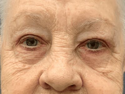 Blepharoplasty Before & After Gallery - Patient 293269 - Image 2