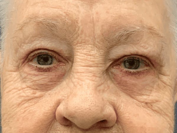 Blepharoplasty Before & After Gallery - Patient 293269 - Image 2