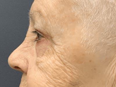Blepharoplasty Before & After Gallery - Patient 293269 - Image 4