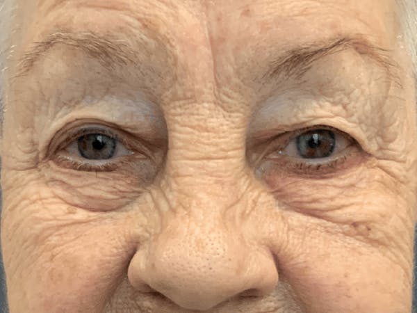Blepharoplasty Before & After Gallery - Patient 293269 - Image 1
