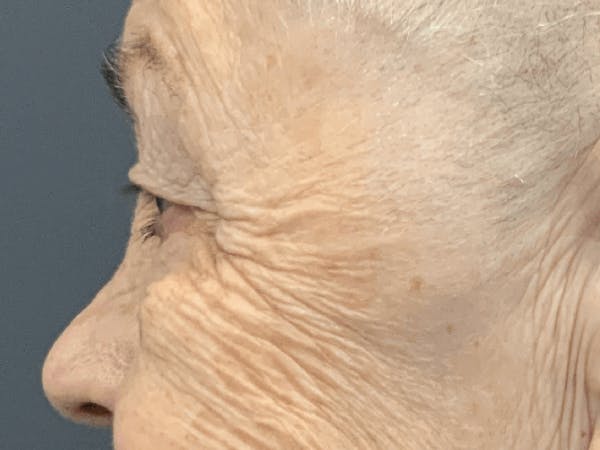 Blepharoplasty Before & After Gallery - Patient 293269 - Image 3