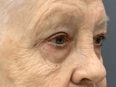Blepharoplasty Before & After Gallery - Patient 293269 - Image 10