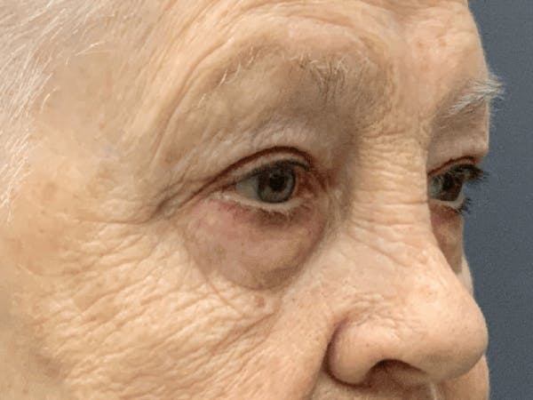 Blepharoplasty Before & After Gallery - Patient 293269 - Image 10