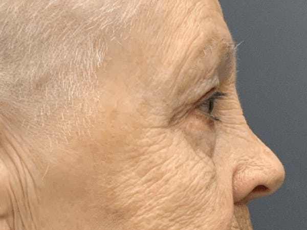 Blepharoplasty Before & After Gallery - Patient 293269 - Image 8