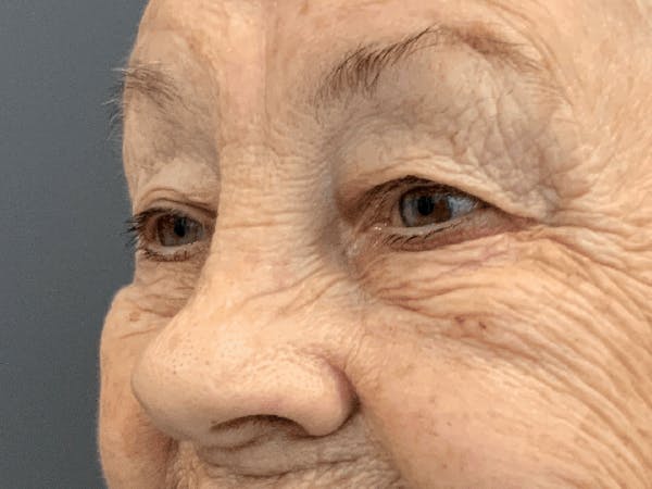 Blepharoplasty Before & After Gallery - Patient 293269 - Image 5