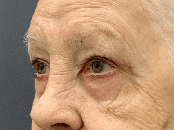 Blepharoplasty Before & After Gallery - Patient 293269 - Image 6