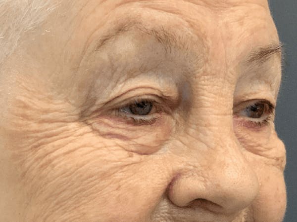 Blepharoplasty Before & After Gallery - Patient 293269 - Image 9
