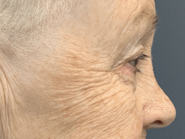 Blepharoplasty Before & After Gallery - Patient 293269 - Image 7
