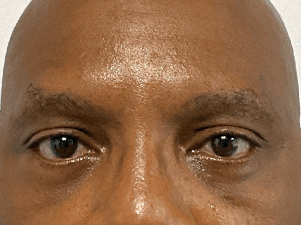Blepharoplasty Before & After Gallery - Patient 668116 - Image 2