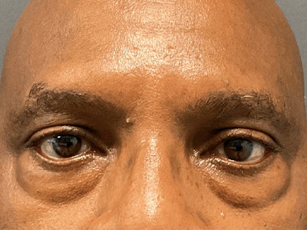 Blepharoplasty Before & After Gallery - Patient 668116 - Image 1