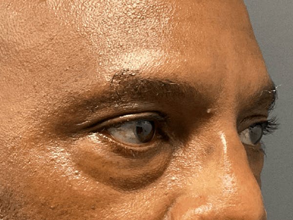 Blepharoplasty Before & After Gallery - Patient 668116 - Image 3