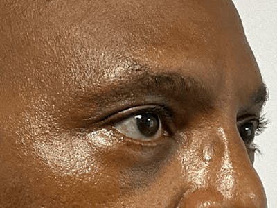 Blepharoplasty Before & After Gallery - Patient 668116 - Image 4