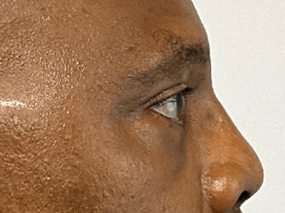 Blepharoplasty Before & After Gallery - Patient 668116 - Image 6