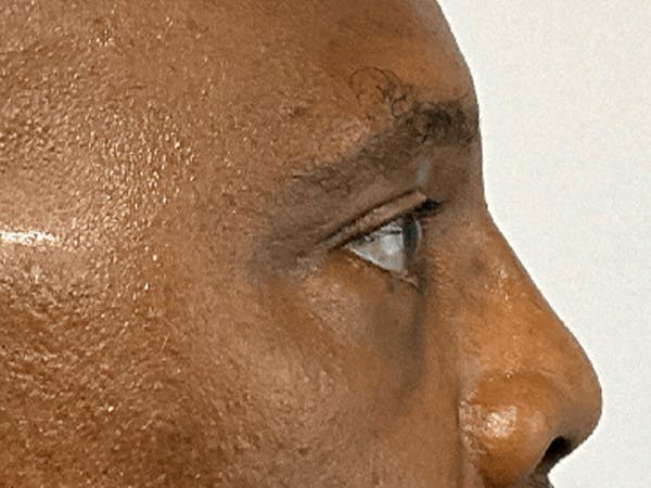 Blepharoplasty Before & After Gallery - Patient 668116 - Image 6