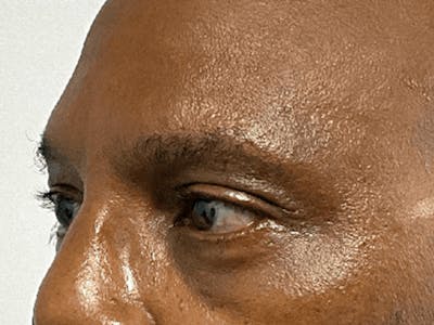 Blepharoplasty Before & After Gallery - Patient 668116 - Image 10