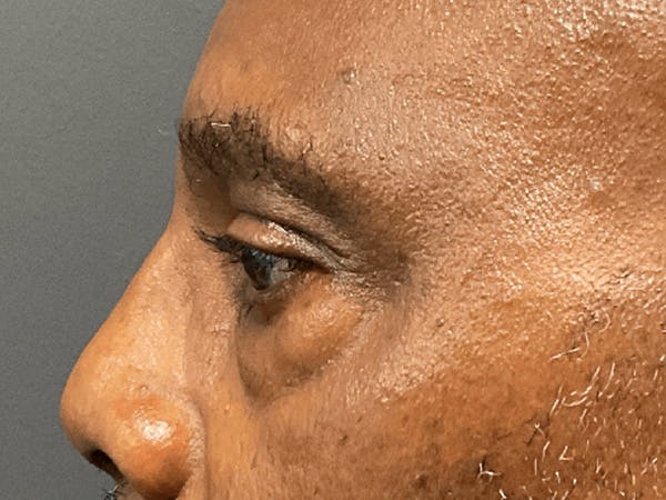 Blepharoplasty Before & After Gallery - Patient 668116 - Image 9