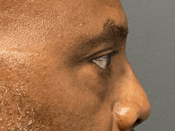 Blepharoplasty Before & After Gallery - Patient 668116 - Image 5