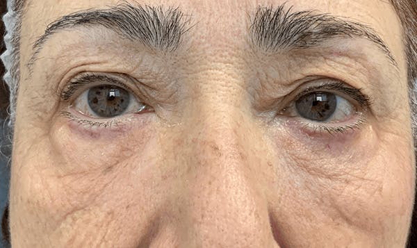 Blepharoplasty Before & After Gallery - Patient 255397 - Image 1