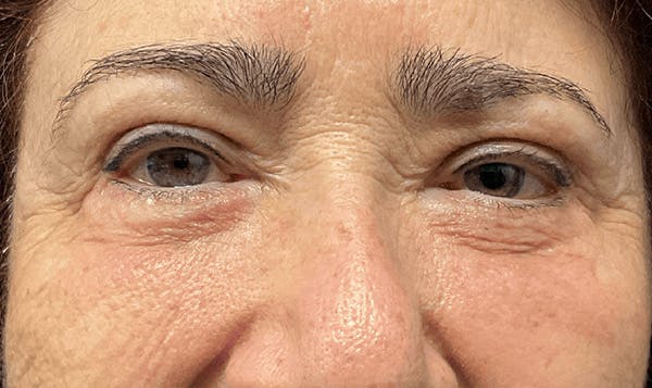 Blepharoplasty Before & After Gallery - Patient 255397 - Image 2