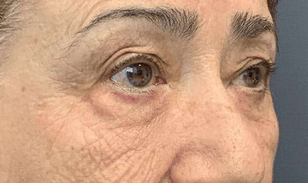 Blepharoplasty Before & After Gallery - Patient 255397 - Image 3